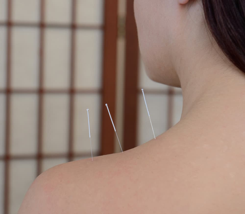 Acupuncture Treatment in Leighton Buzzard