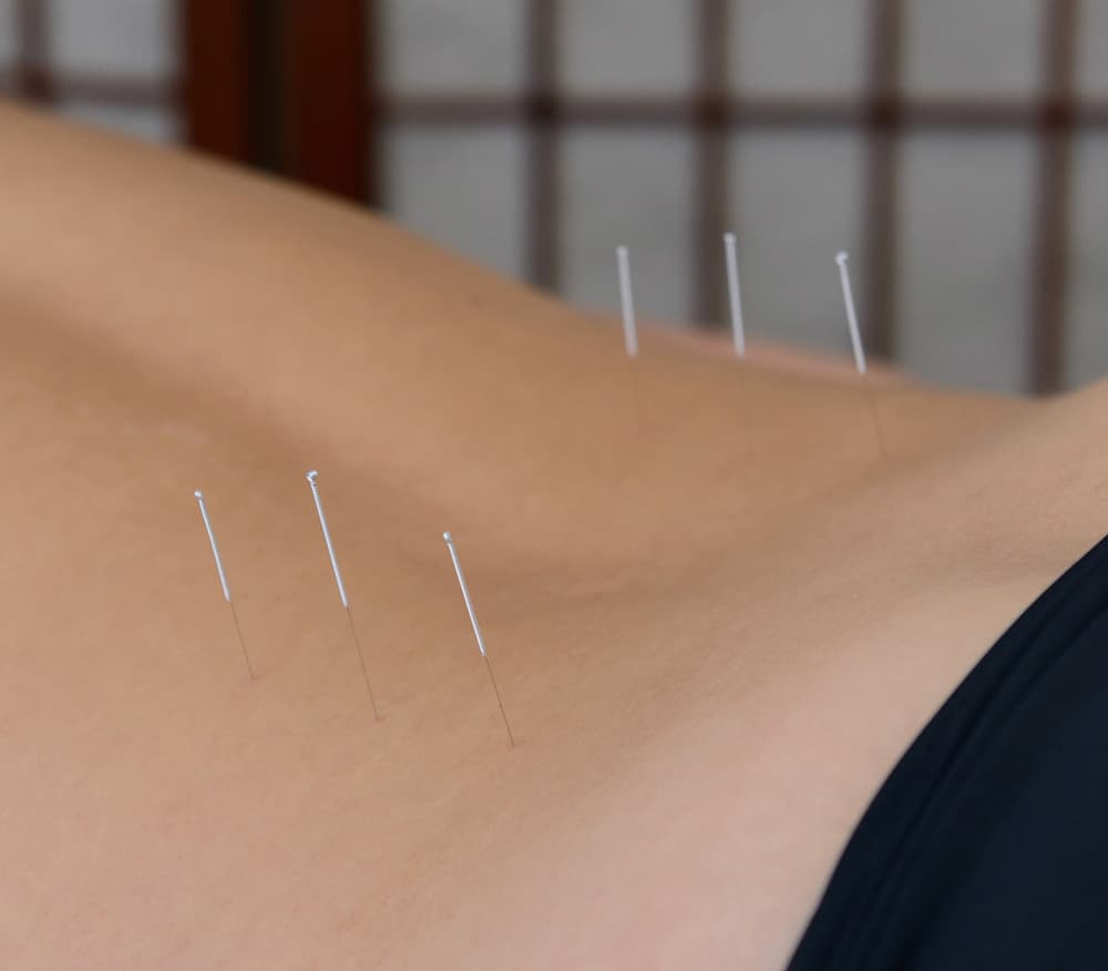 Acupuncture Leighton Buzzard