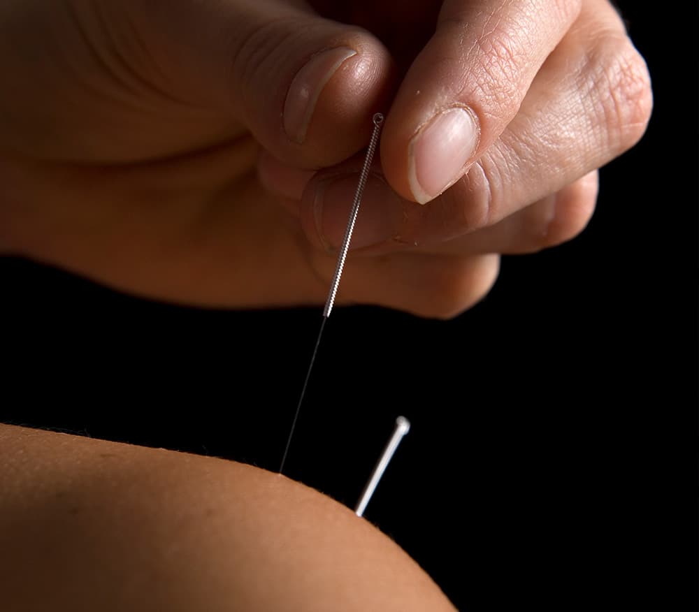 Acupuncture Leighton Buzzard