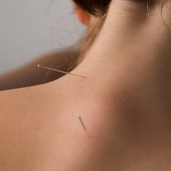 Cosmetic Acupuncture